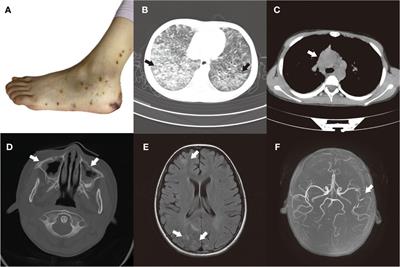 Eosinophilic granulomatous polyangiitis with central nervous system involvement in children: a case report and literature review